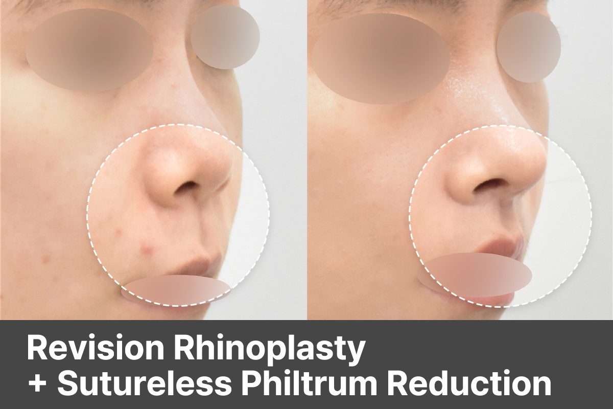 Revision Rhinoplasty + Sutureless Philtrum Reduction in Seoul, Korea