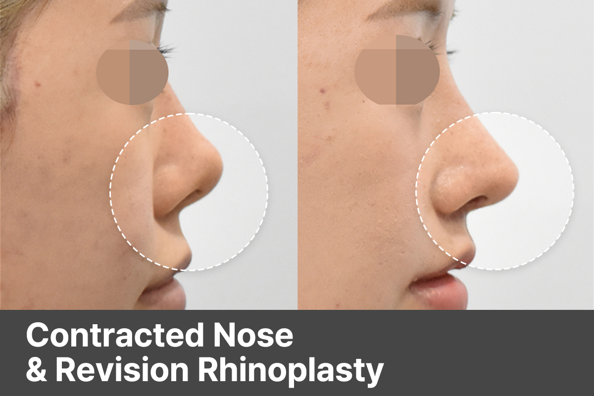  Revision Rhinoplasty for Contracted Nose & Philtrum Angle Correction in Korea