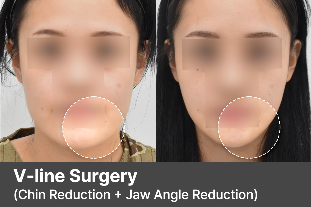 V-line Surgery in Korea (Chin + Jaw Reduction) for a Natural Slim Jawline | RESPECT Plastic Surgery